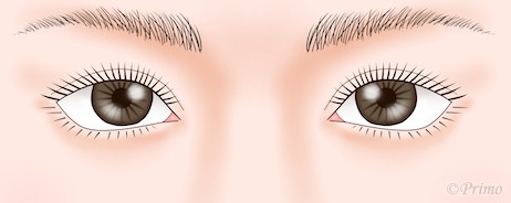 下眼瞼拡大術（たれ目形成）イラスト